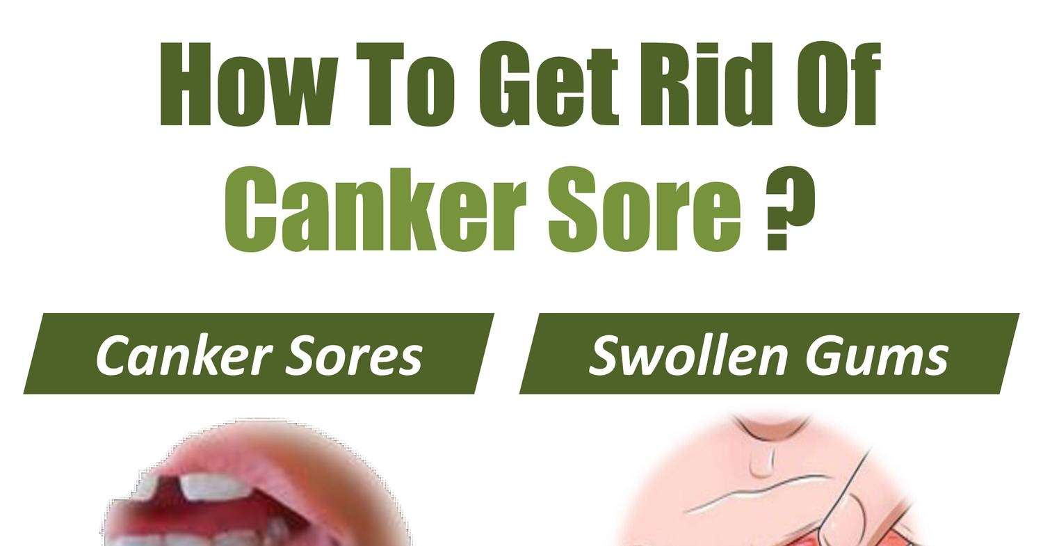 Canker Sores Treatment.pdf DocDroid